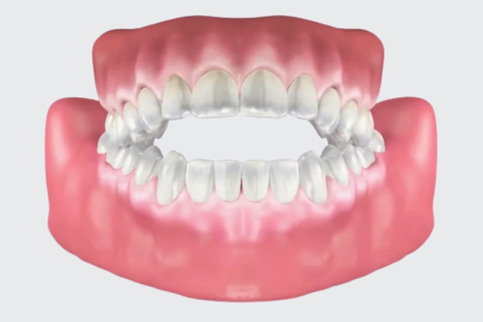 Early Bite Issues in Toddlers: What Every Parent Needs to Know